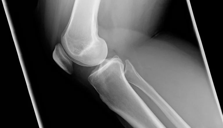 Osteotomia ginocchio